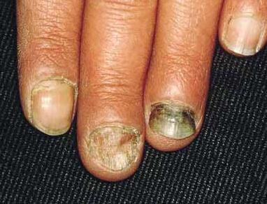 灰指甲的早期症状